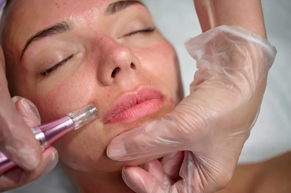 Microneedling image
